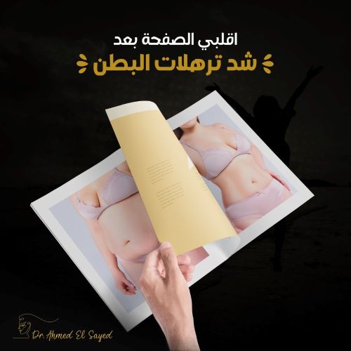 اسرع طريقة لشد ترهلات البطن
